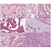 <b>【佳學(xué)基因檢測】腎臟癌靶向藥物基因檢測（Kidney Cancer)</b>